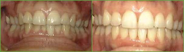 Crossbite teeth before and after — Buffalo Grove, IL — Rosen Orthodontics Crossbite teeth before and after — Buffalo Grove, IL — Rosen Orthodontics