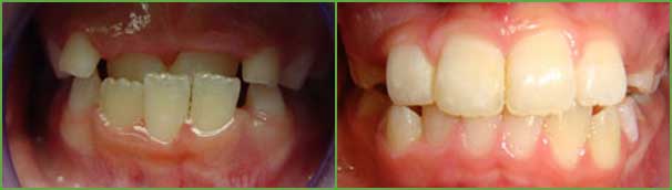 Anterior crossbite teeth before and after — Buffalo Grove, IL — Rosen Orthodontics Anterior crossbite teeth before and after — Buffalo Grove, IL — Rosen Orthodontics