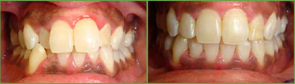 Severe crowding before and after — Buffalo Grove, IL — Rosen Orthodontics Severe crowding before and after — Buffalo Grove, IL — Rosen Orthodontics