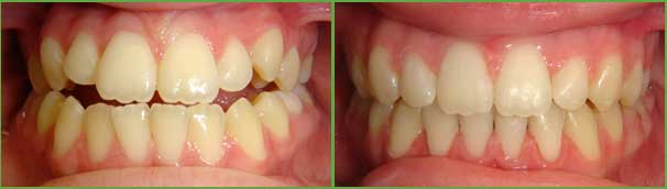 Open bite before and after — Buffalo Grove, IL — Rosen Orthodontics Open bite before and after — Buffalo Grove, IL — Rosen Orthodontics