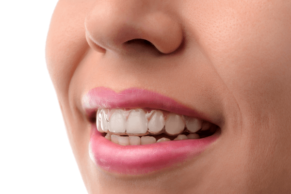 Invisalign clear aligners — Buffalo Grove, IL — Rosen Orthodontics Invisalign clear aligners — Buffalo Grove, IL — Rosen Orthodontics
