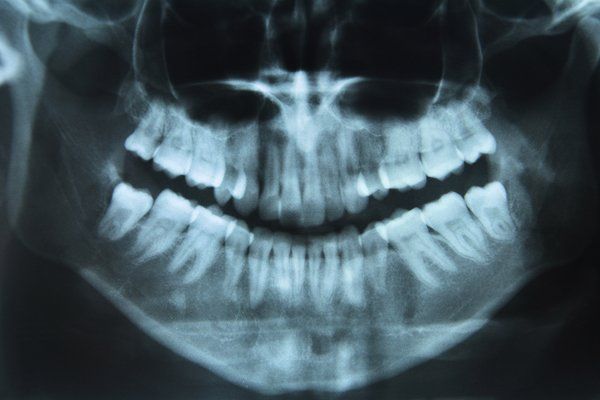 Teeth x-ray — Buffalo Grove, IL — Rosen Orthodontics Teeth x-ray — Buffalo Grove, IL — Rosen Orthodontics