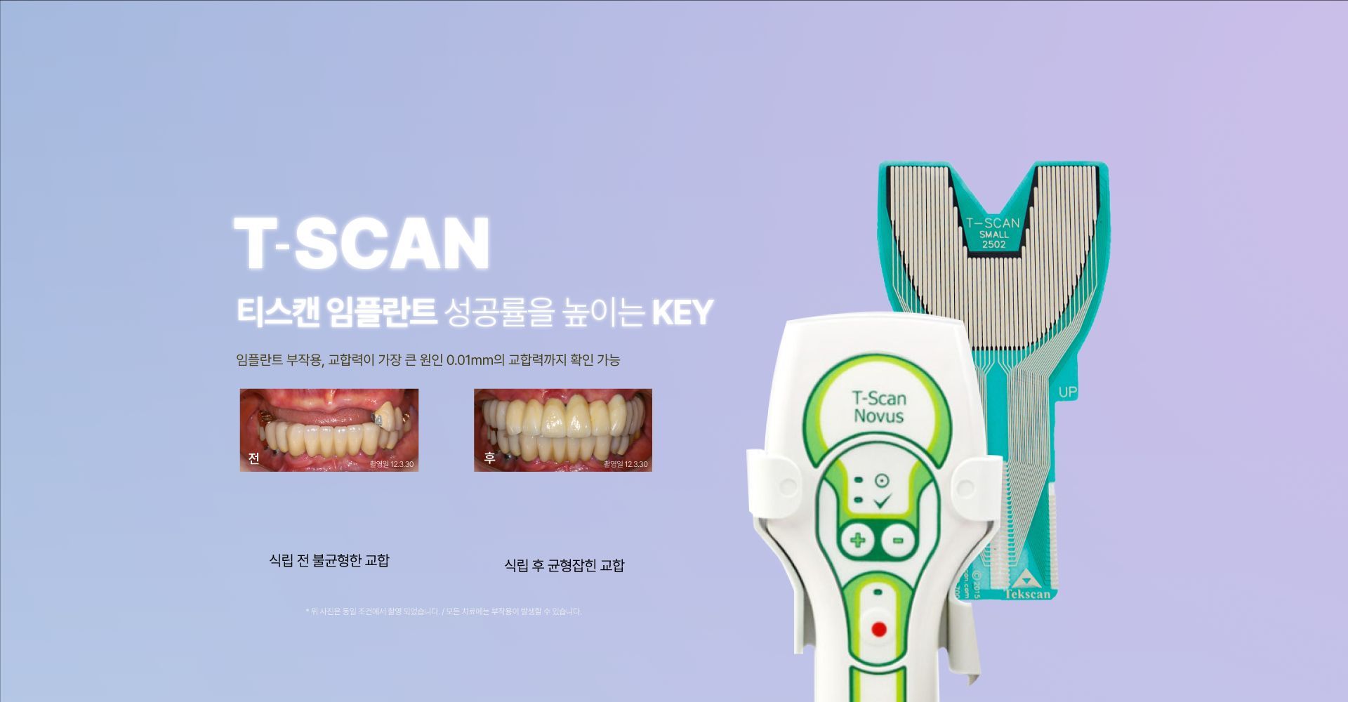 T-Scan Novus digital occlusion sensor with before and after bite comparison of a full-arch implant case