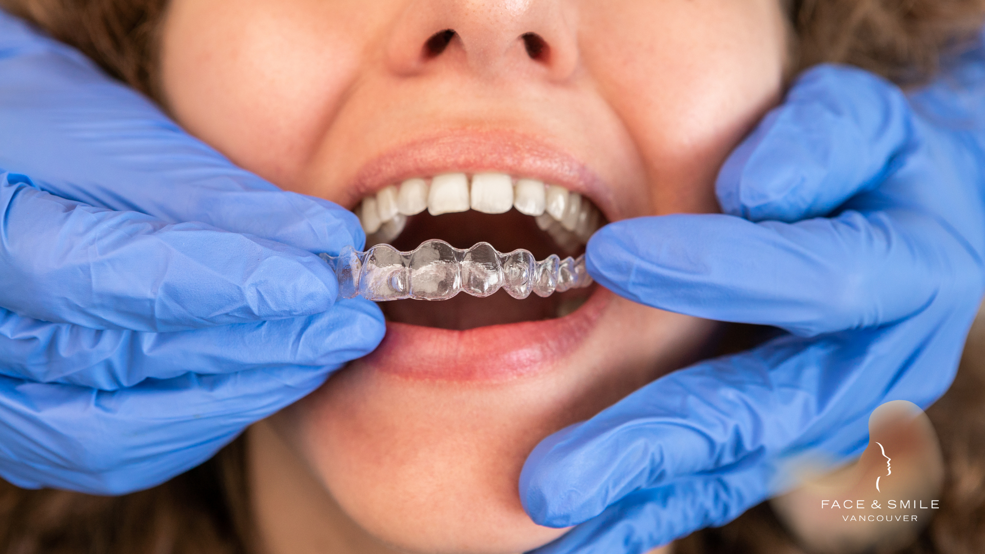 A woman is getting her teeth straightened by a dentist.