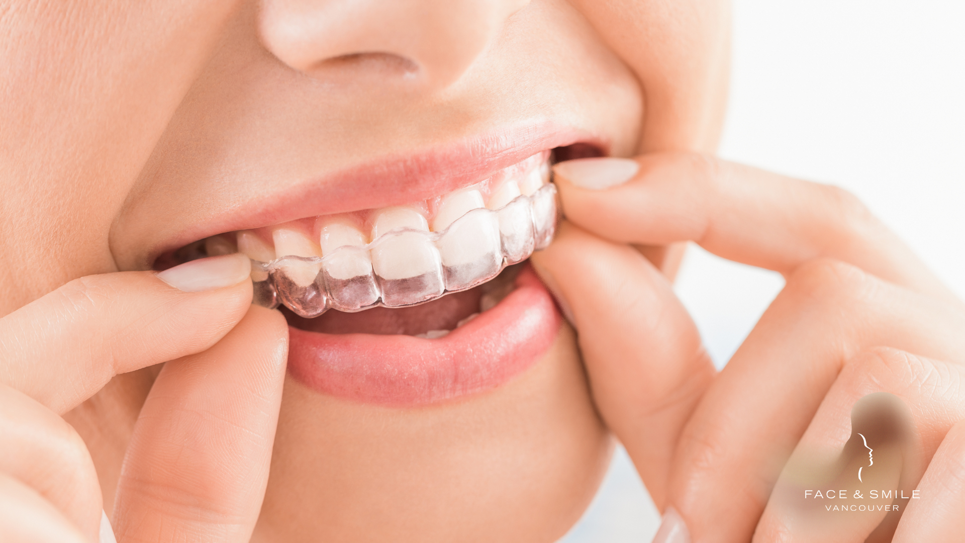 Close-up of a person adjusting clear braces on their teeth with fingers