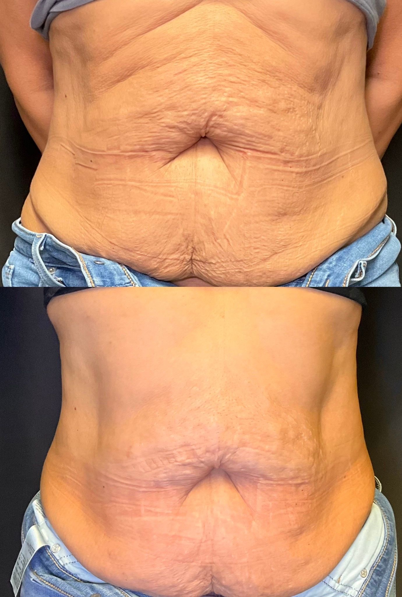 Side-by-side close-up of a abdomen before and after treatment, showing reduced wrinkles and smoother skin