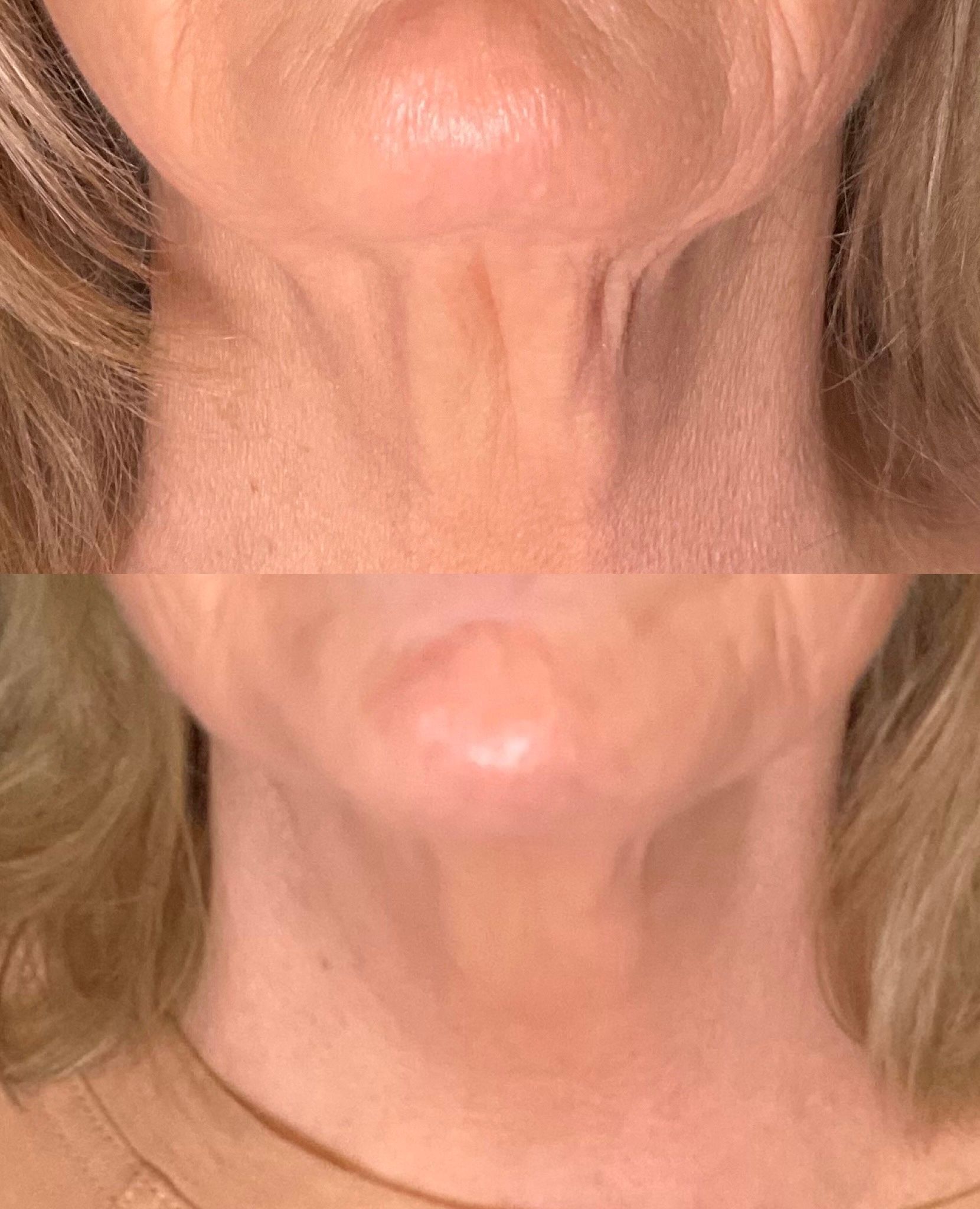 Close-up of a neck before and after cosmetic treatment, showing smoother skin and reduced wrinkles.