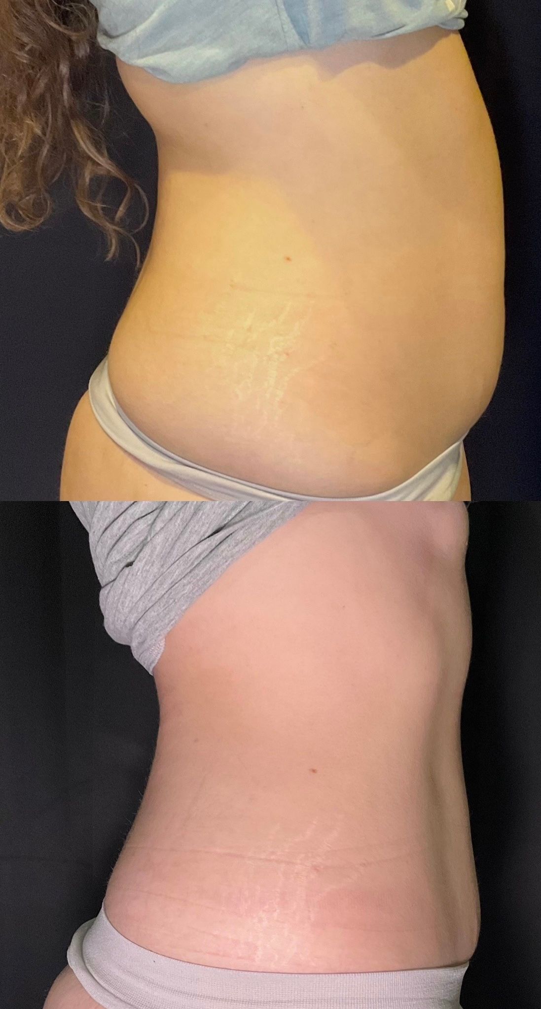 Side-by-side profile views of a torso showing a protruding abdomen and a flatter stomach.