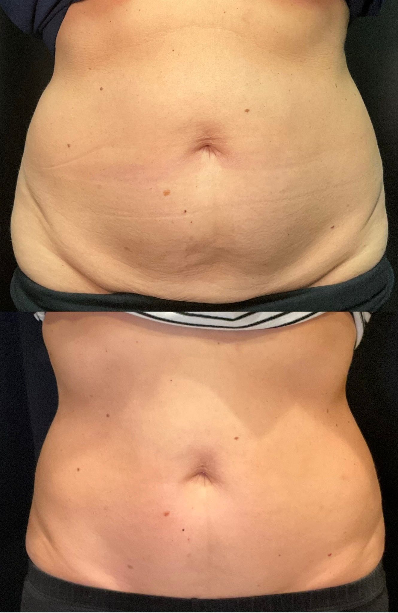 Close-up of a torso with visible belly before-and-after comparison, showing reduced abdominal fullness.