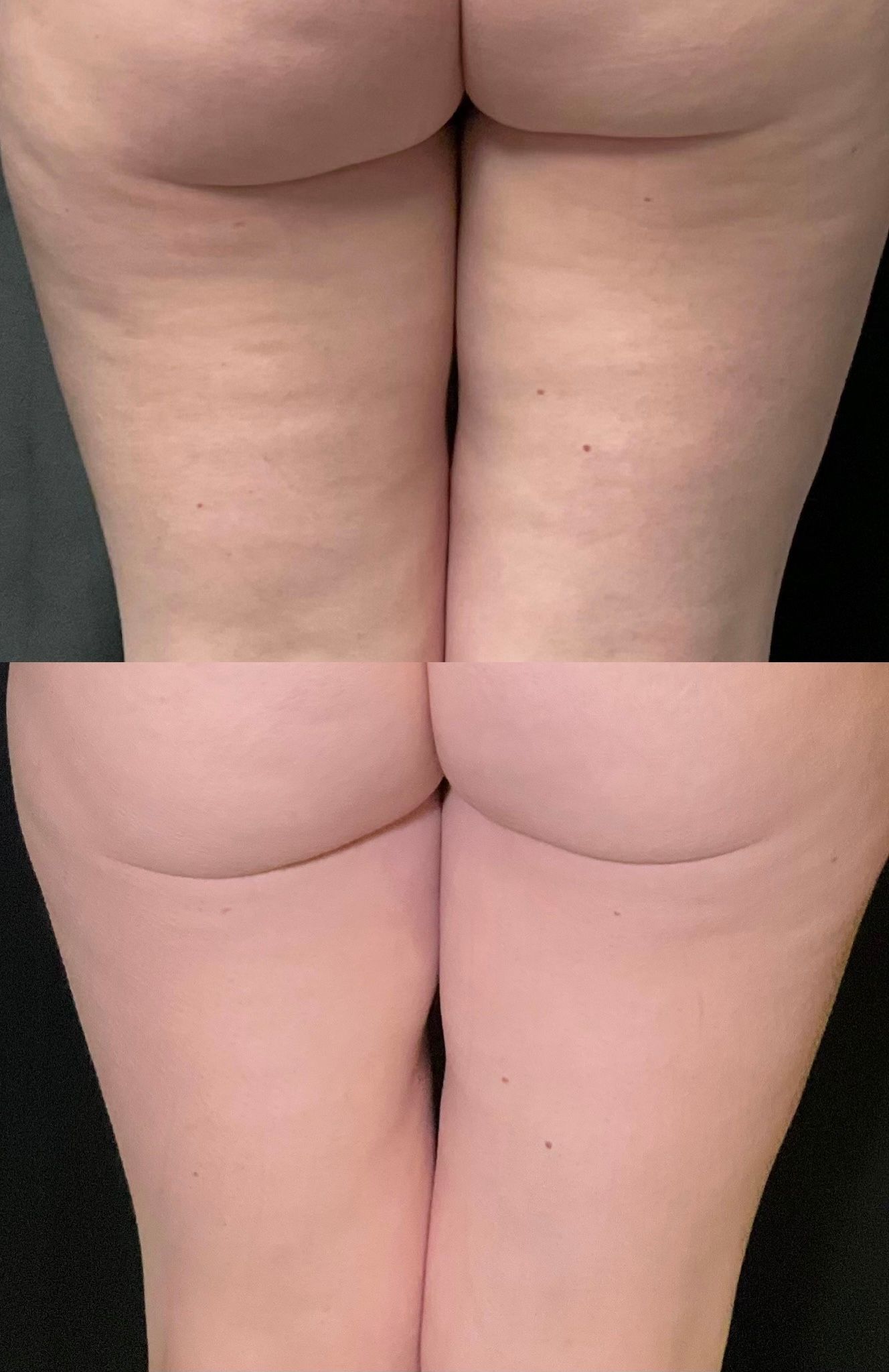 Close-up of two side-by-side rear thigh photos showing skin texture and dimpling differences.