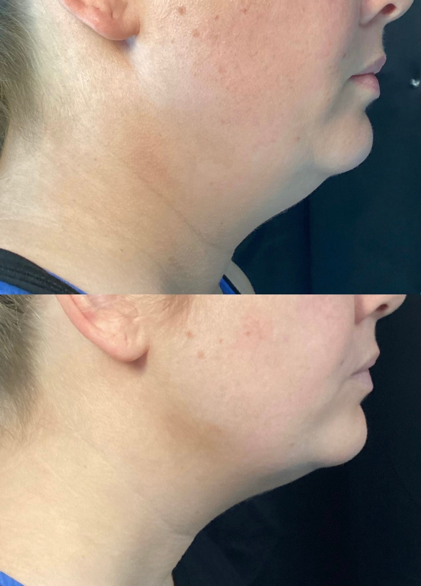 Side-by-side profile close-up of a neck and jawline, showing before-and-after skin changes.