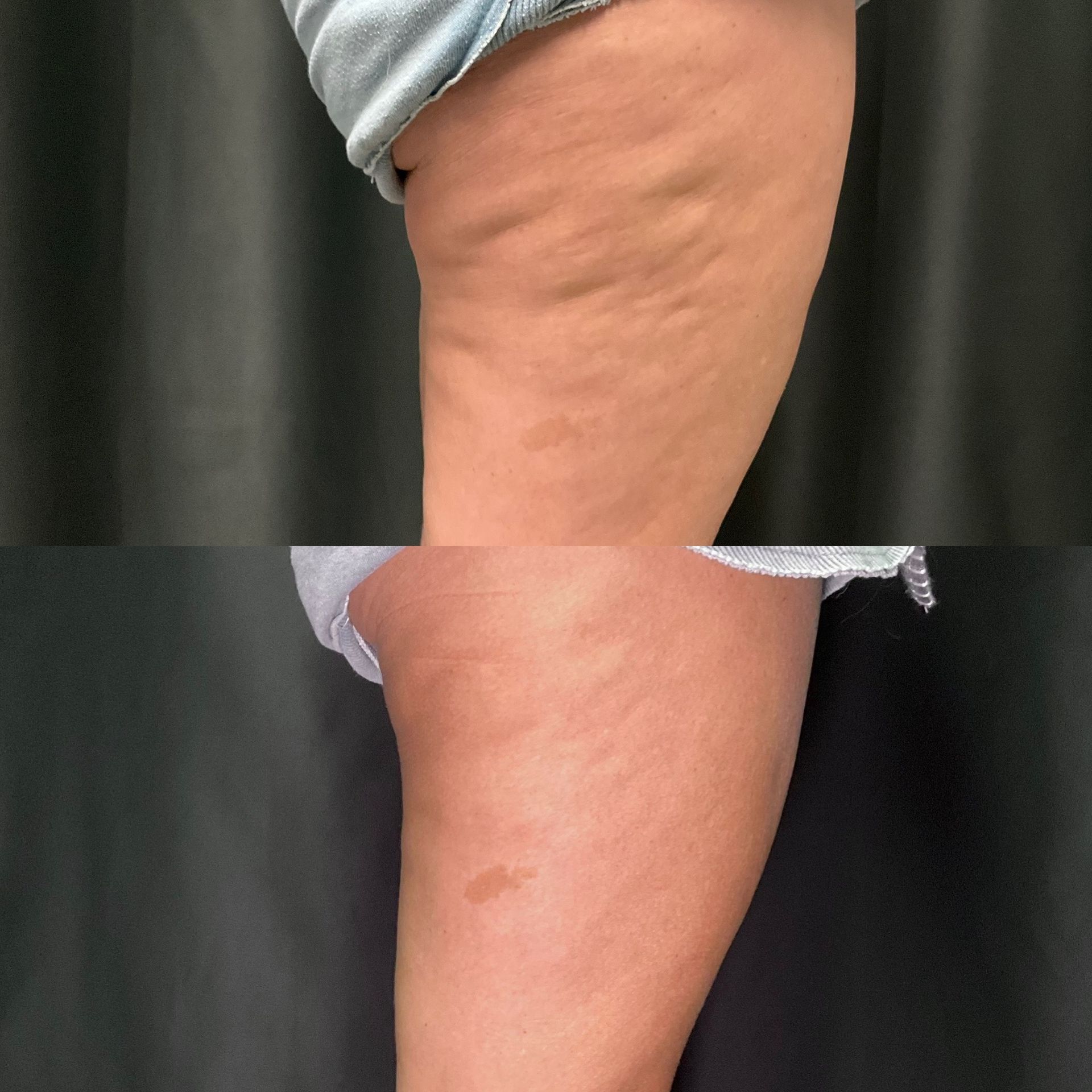 Close-up of a bent leg with a pronounced bulge on the calf, viewed against a dark background.