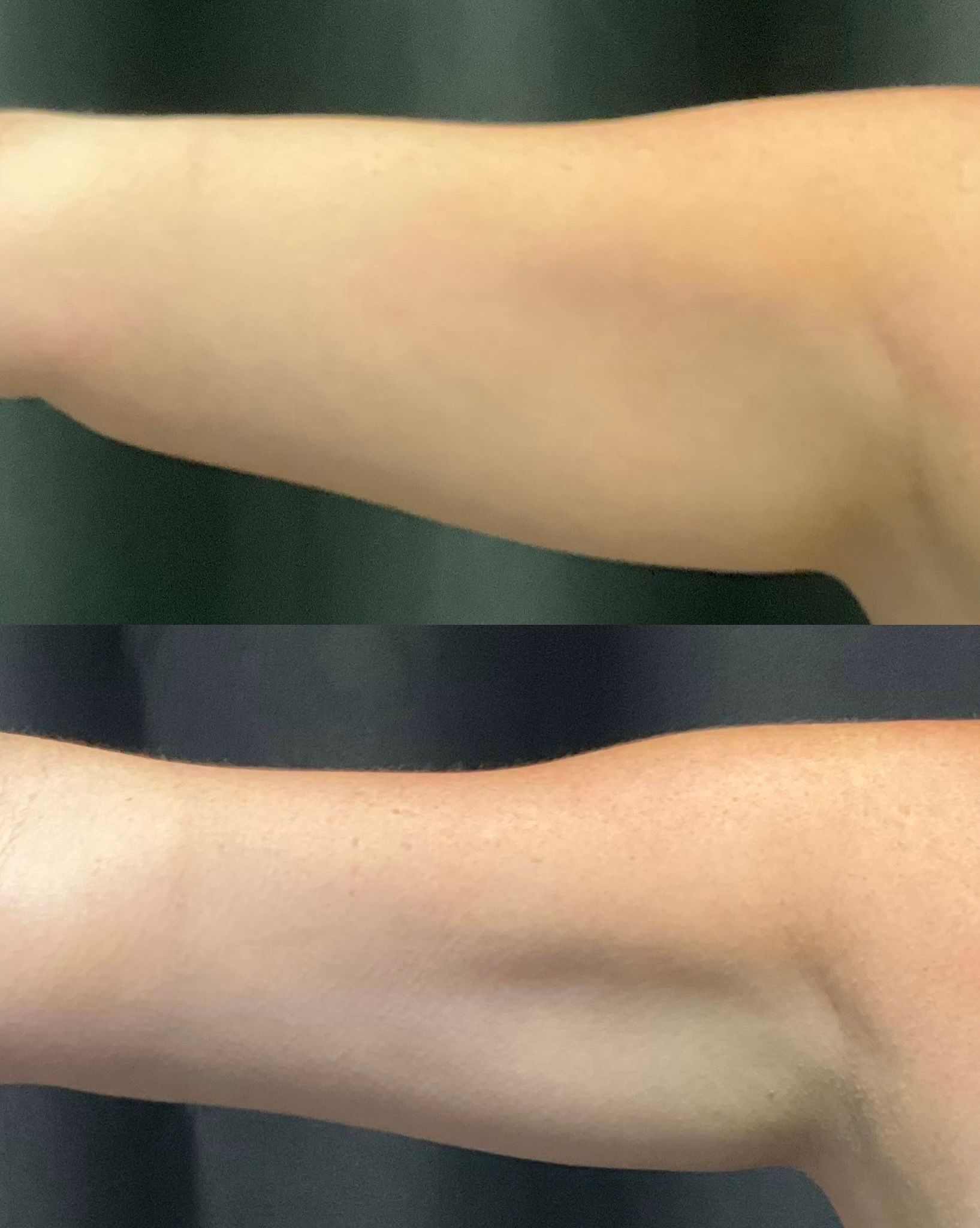Side-by-side close-up of an arm before and after, showing a smoother, lighter skin patch