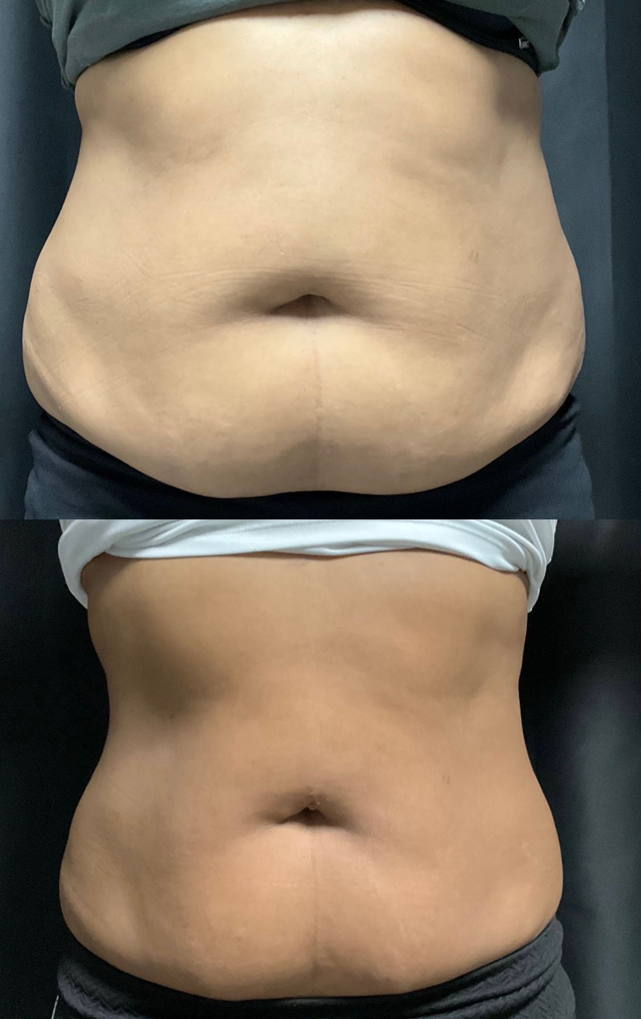 Two stacked torso photos showing abdomen before and after weight loss