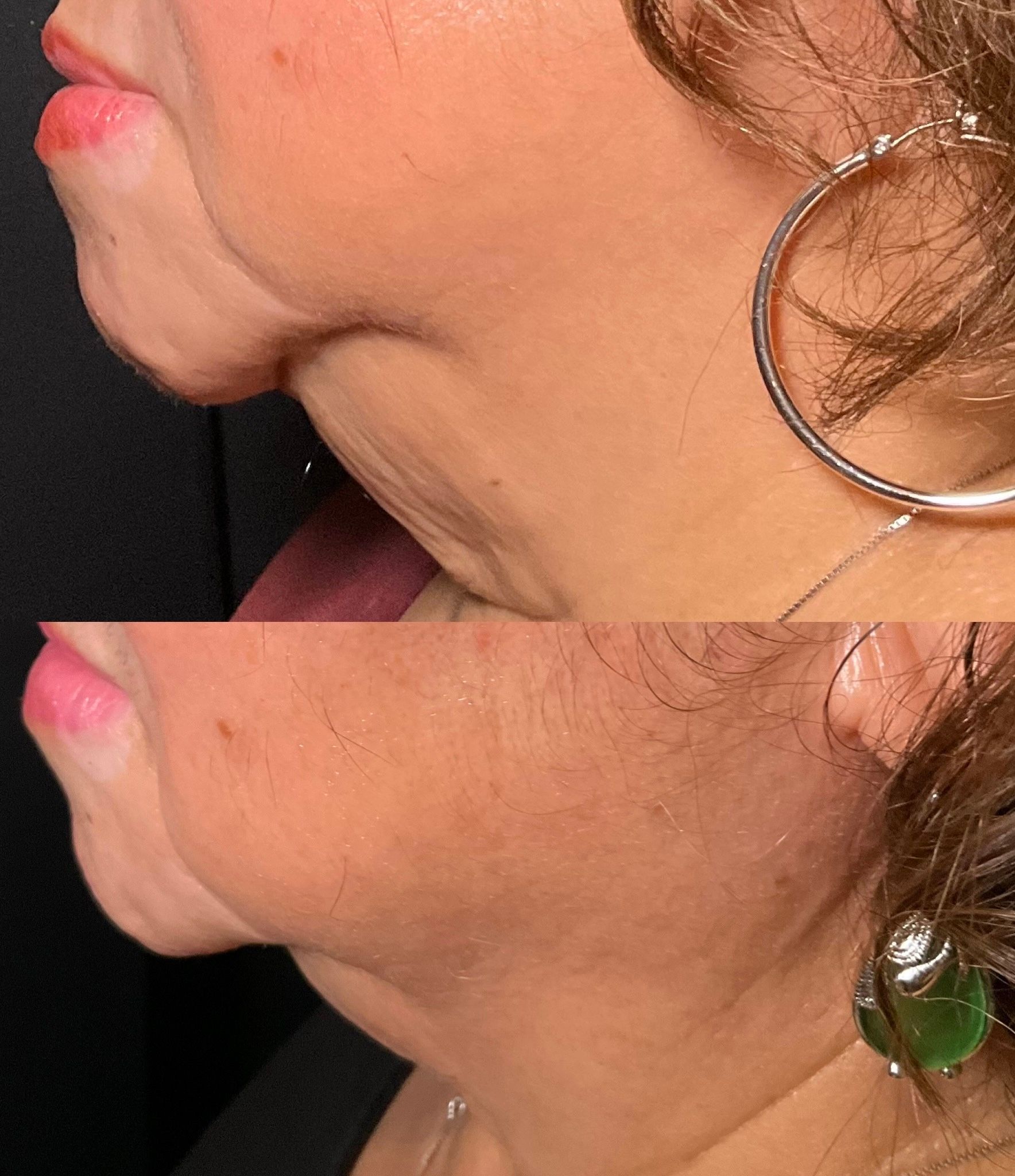 Side-by-side close-up profile of a person's chin and neck before and after treatment.