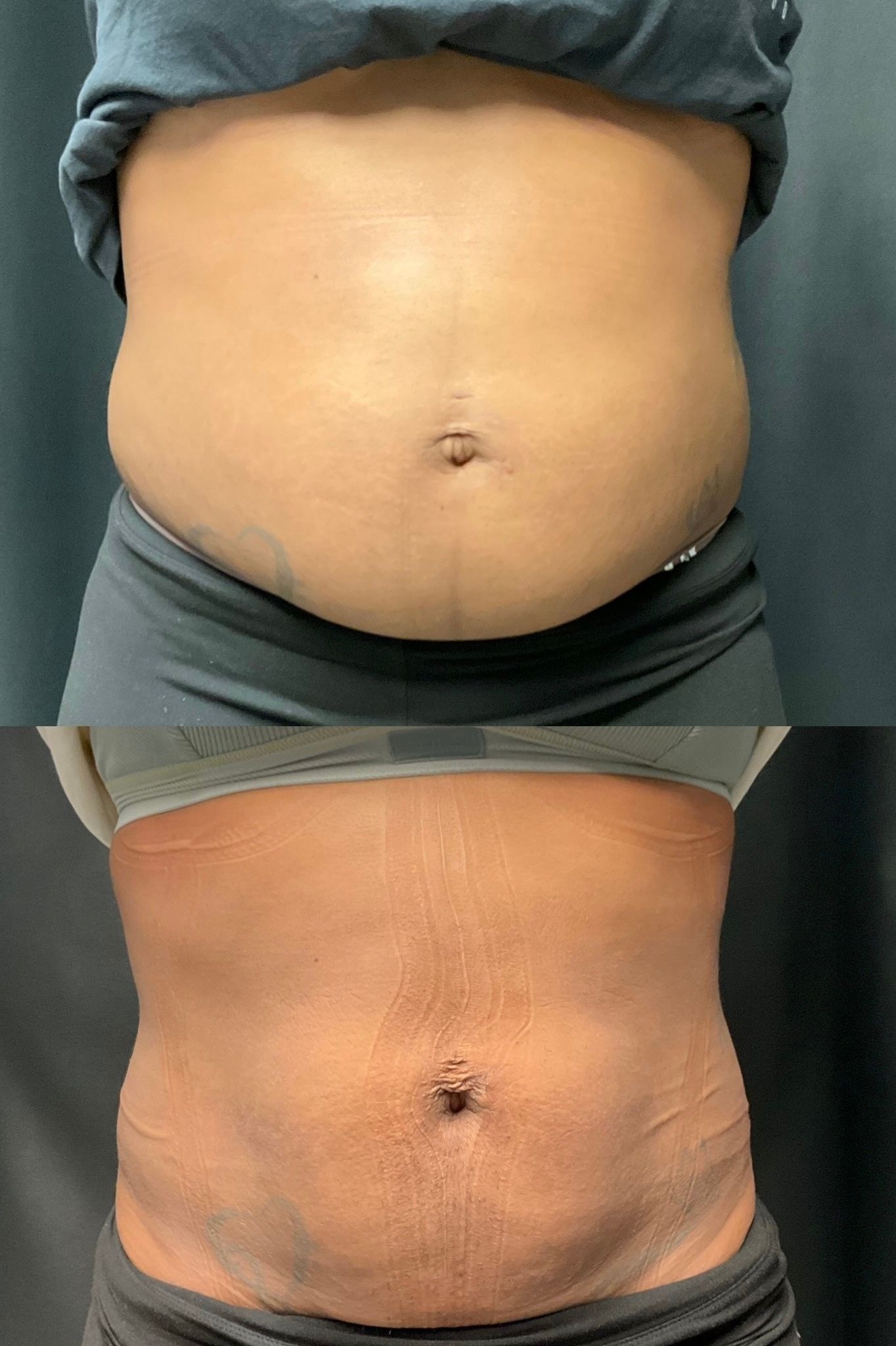 Side-by-side abdomen photos showing before and after; the lower belly appears flatter and more toned.