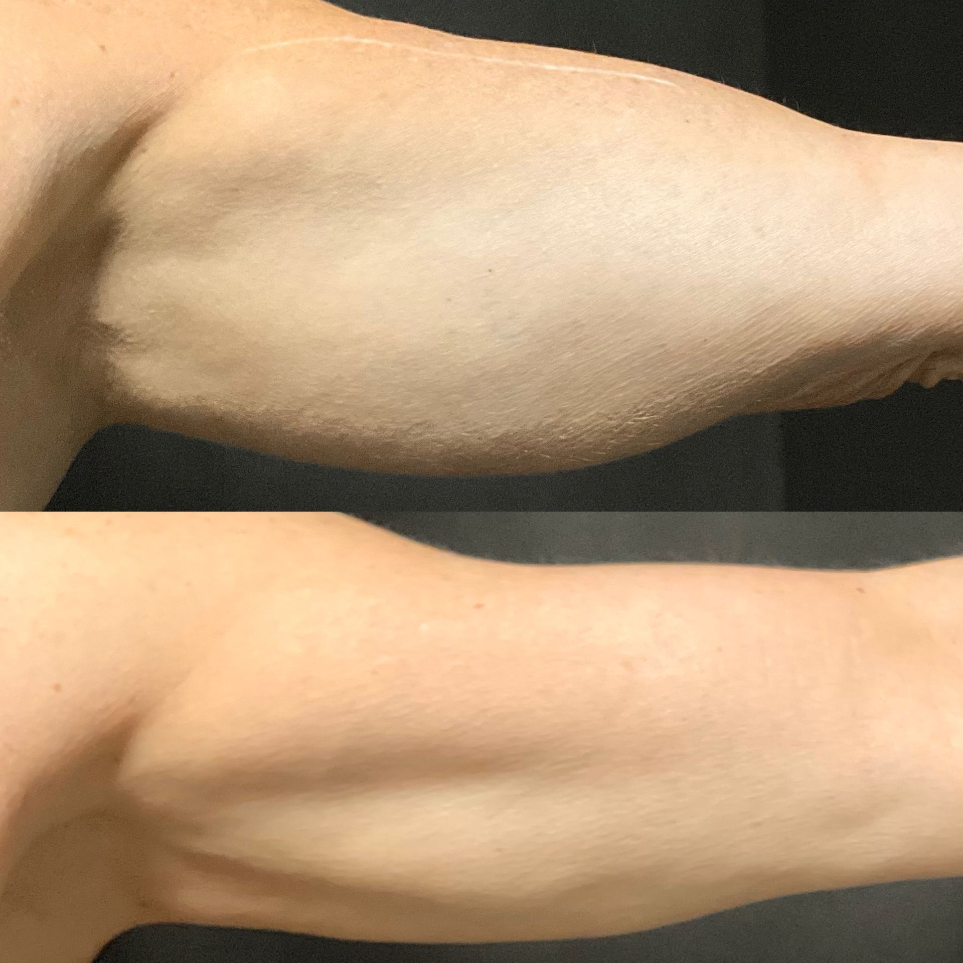 Side-by-side close-up of an arm flexed before and after muscle tightening, against a dark background
