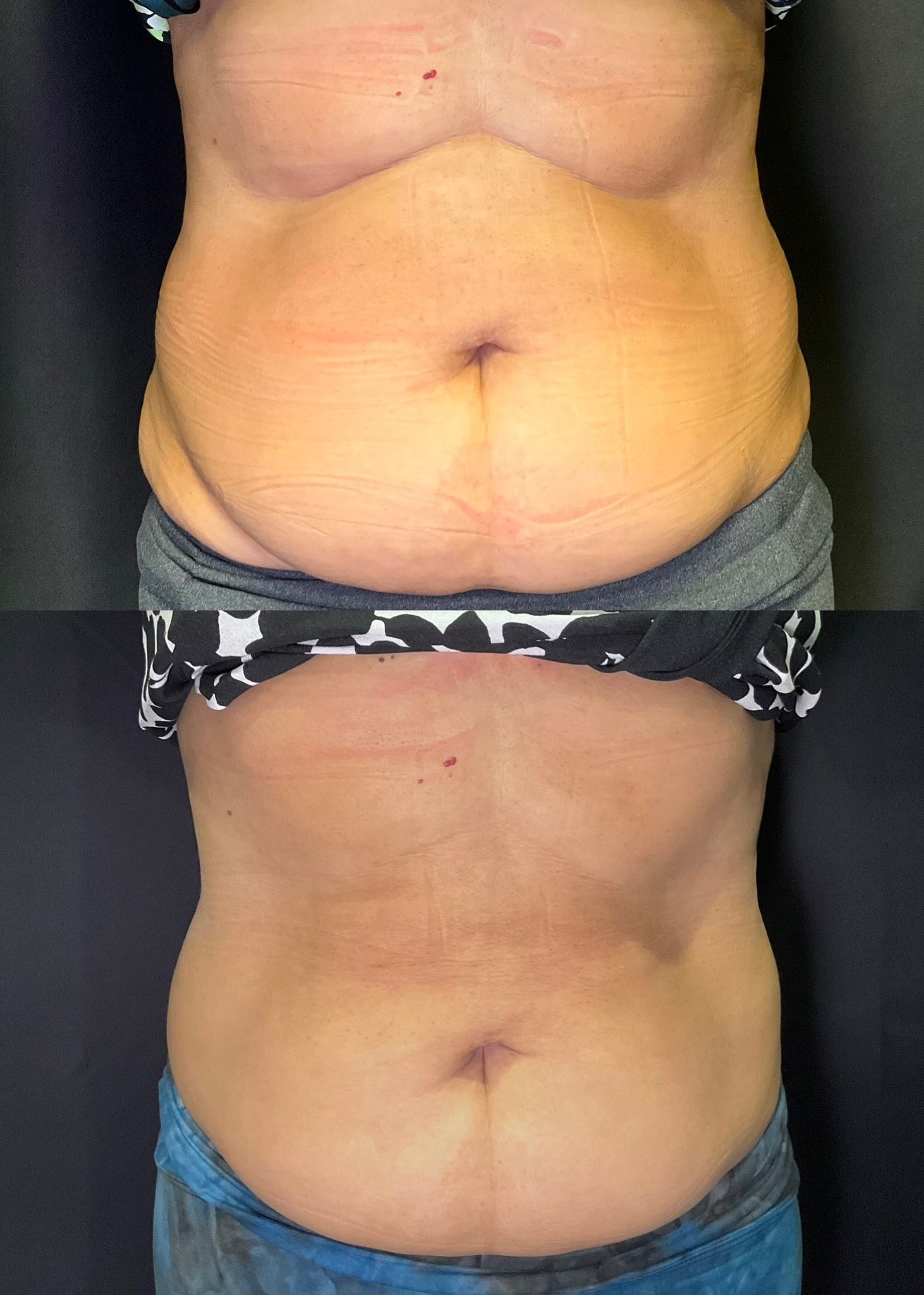 Two side-by-side torso photos showing a bare abdomen with different lighting or posture.
