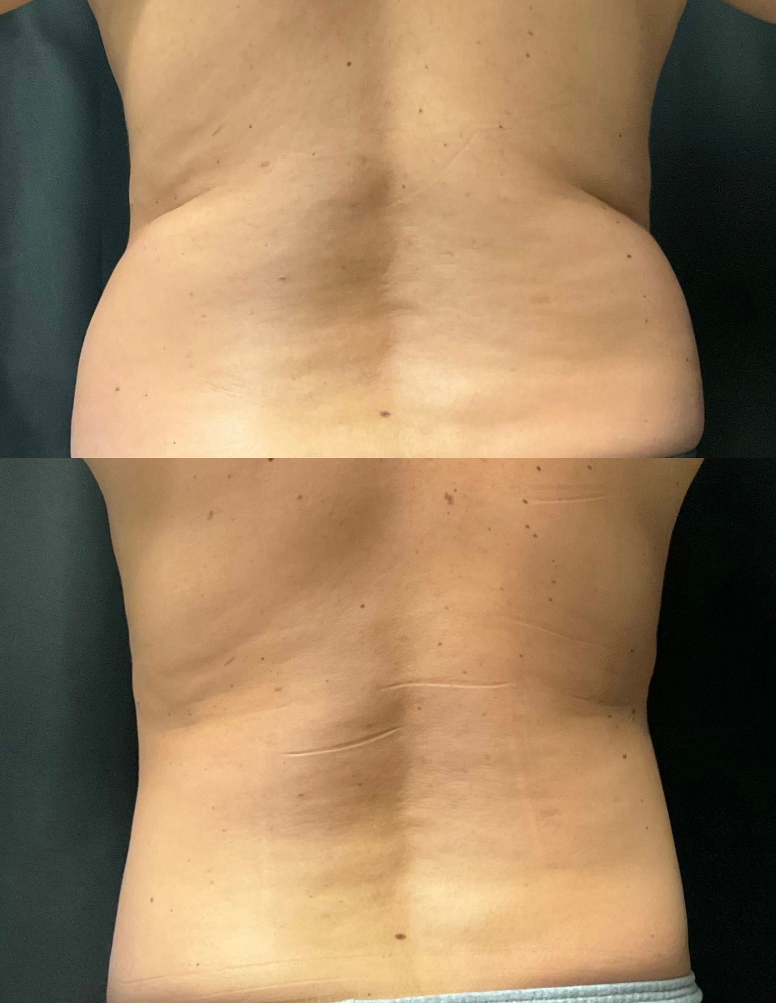 Back view of a bare torso showing lower back skin folds and a horizontal image seam