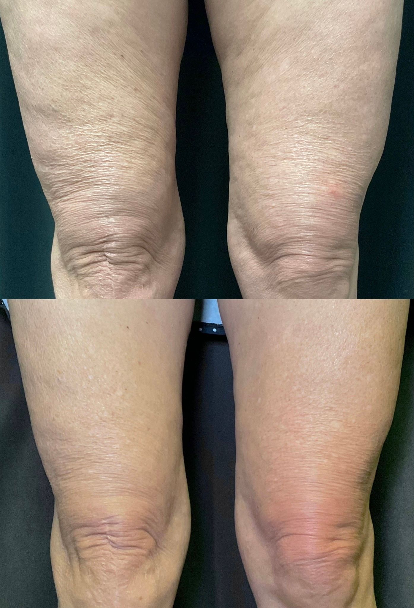 Before-and-after close-up of knees, showing skin tone and condition changes.