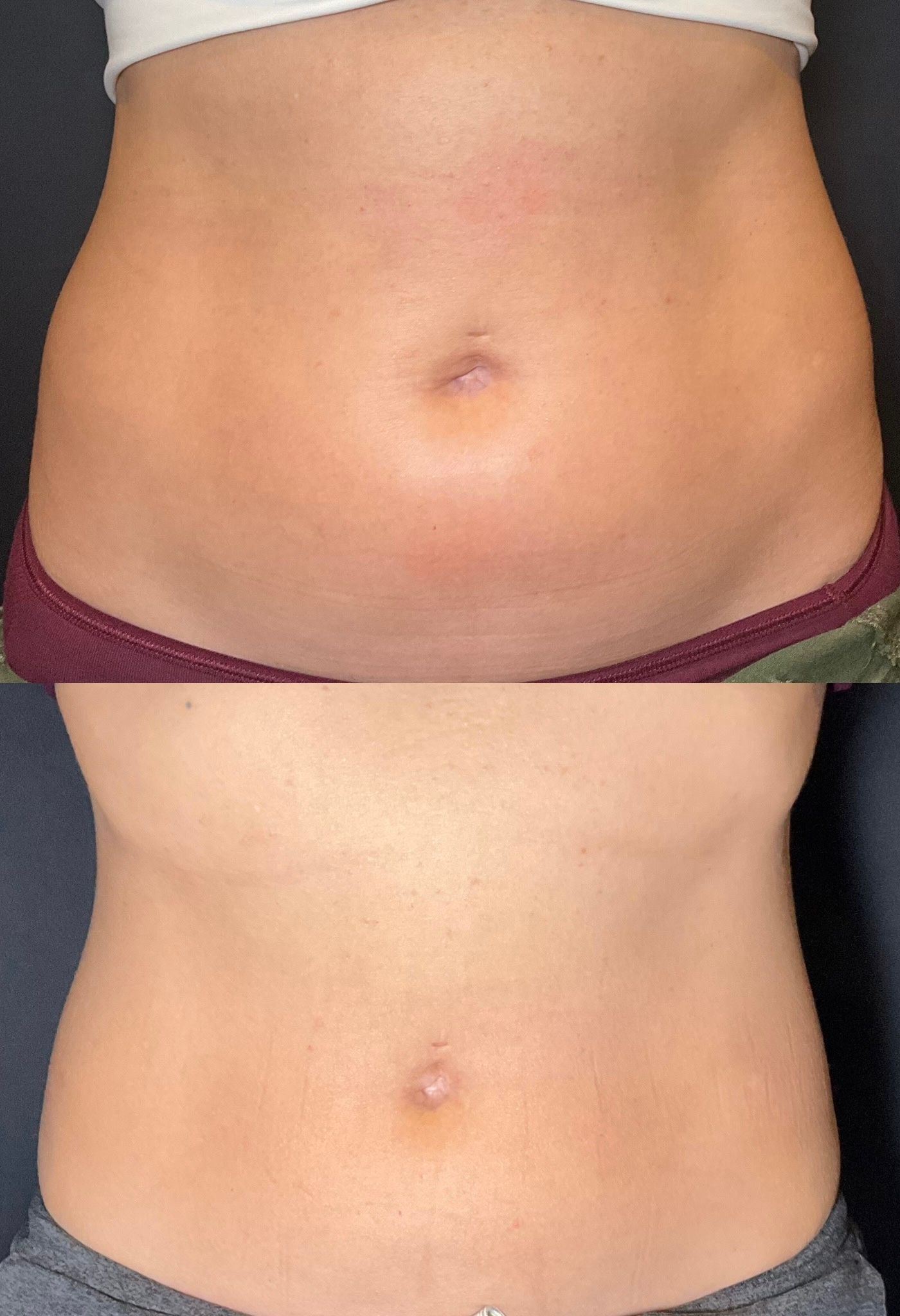 Two stacked abdominal photos showing a bare torso from waist to chest, before and after comparison