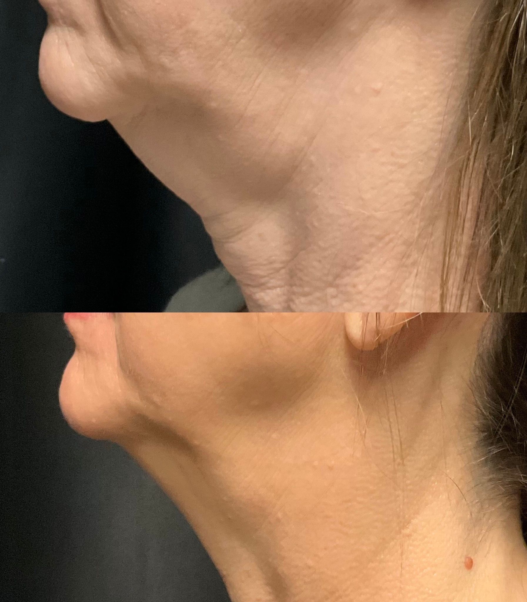 Side-by-side close-up of a neck and jawline, showing skin before and after treatment.