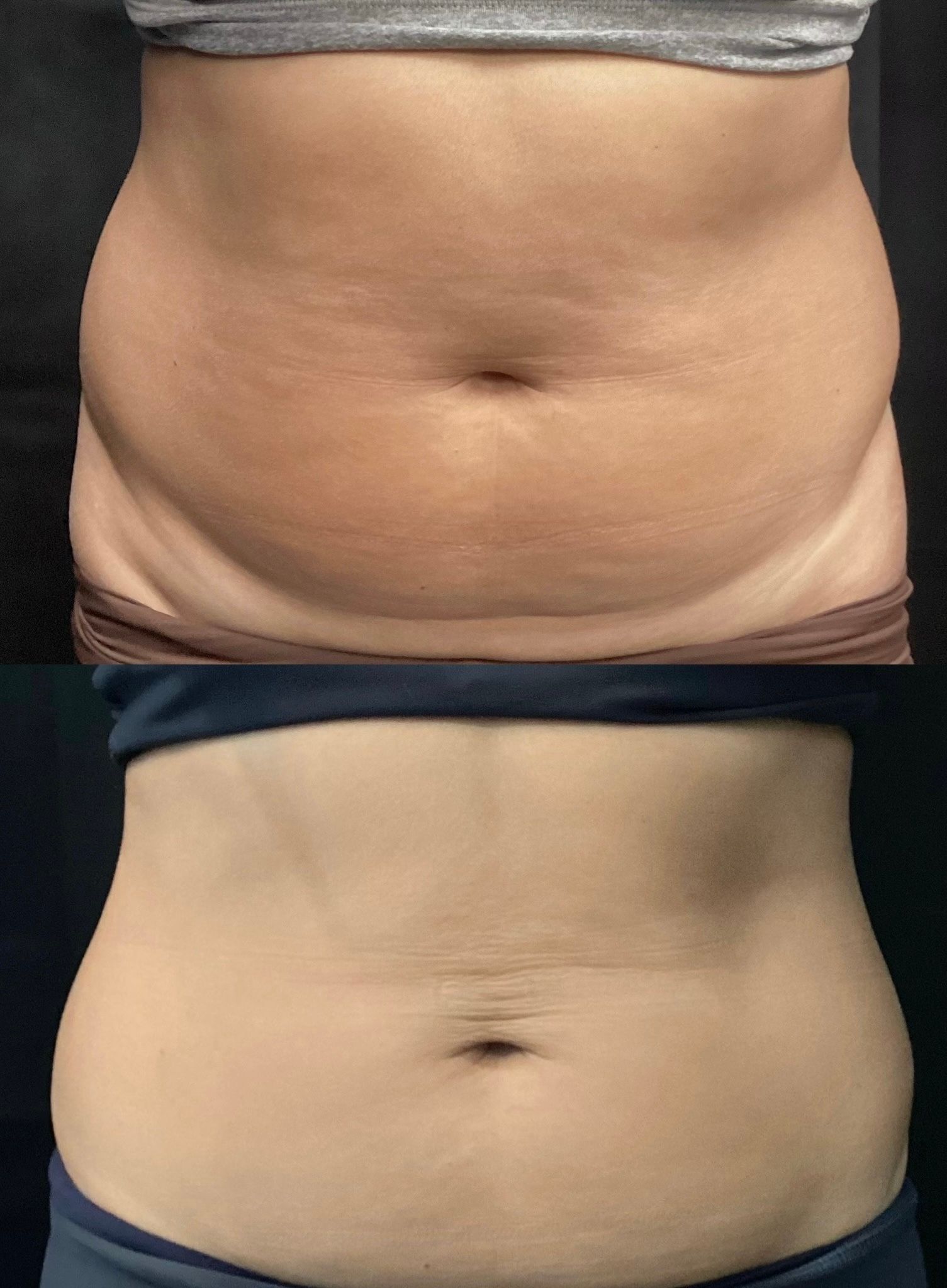 Two side-by-side abdomen photos showing a before-and-after comparison