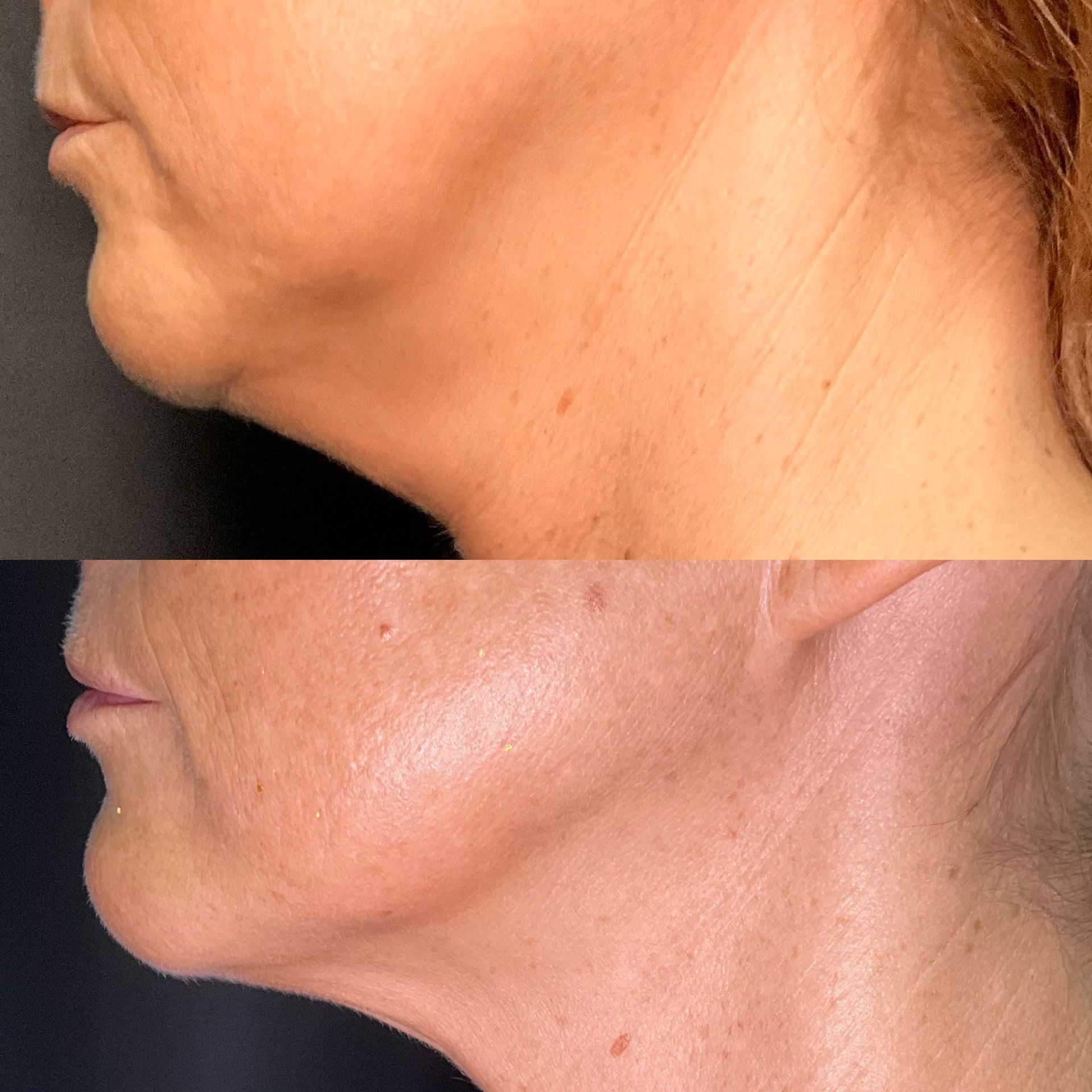 Side profile of a chin and neck, before-and-after skin close-up showing a smoother lower face.