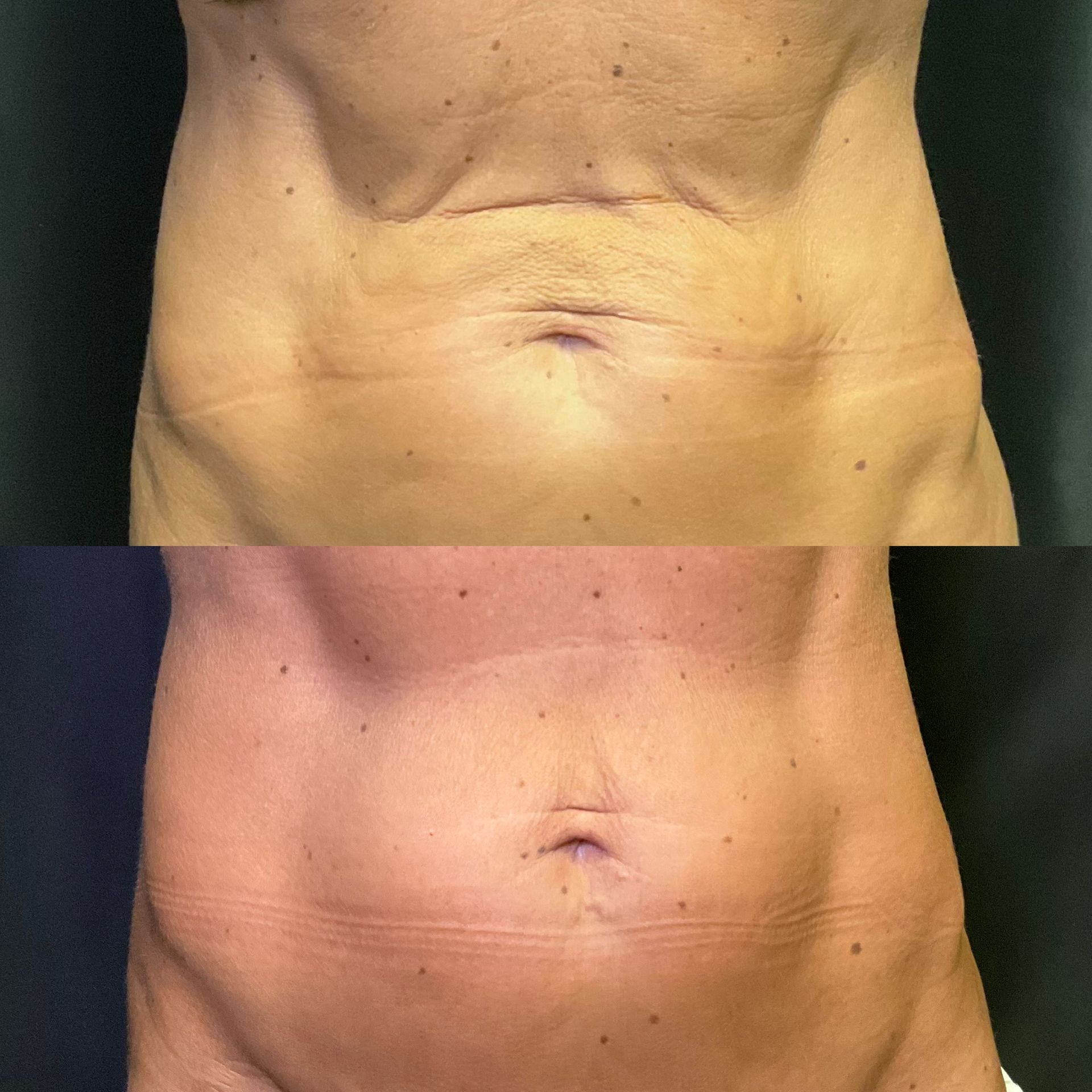 Close-up of a bare torso with post-surgery incisions and abdominal discoloration on a dark background