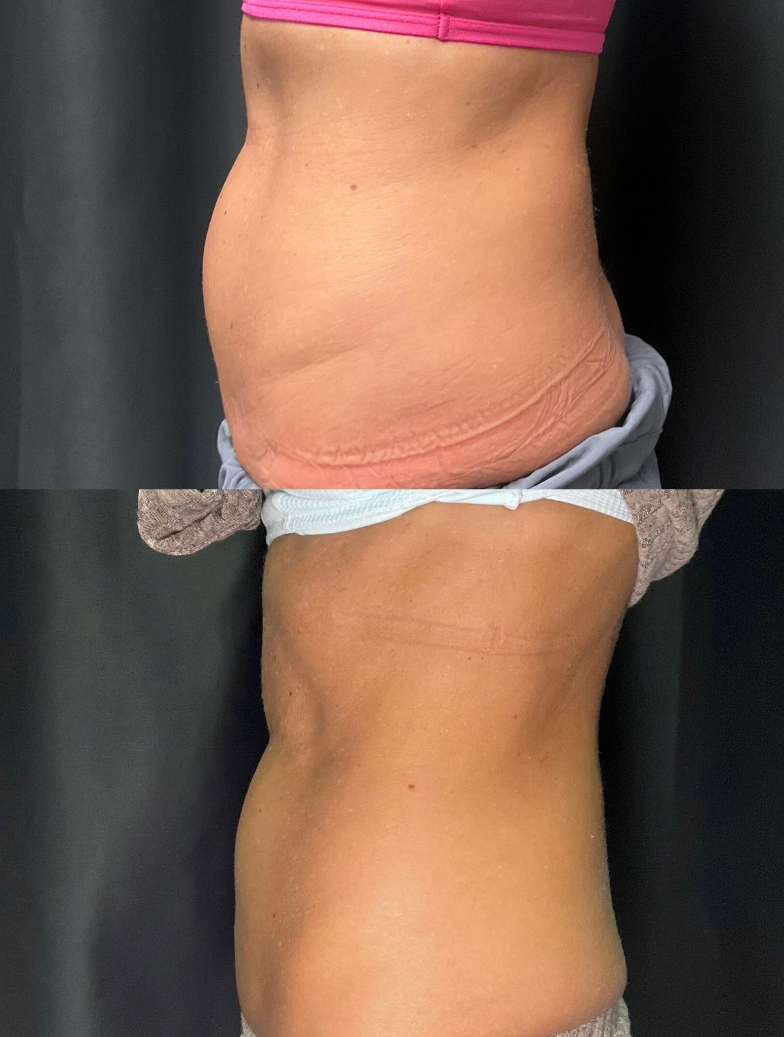 Side-by-side torso views showing a protruding abdomen above and a flatter abdomen below.