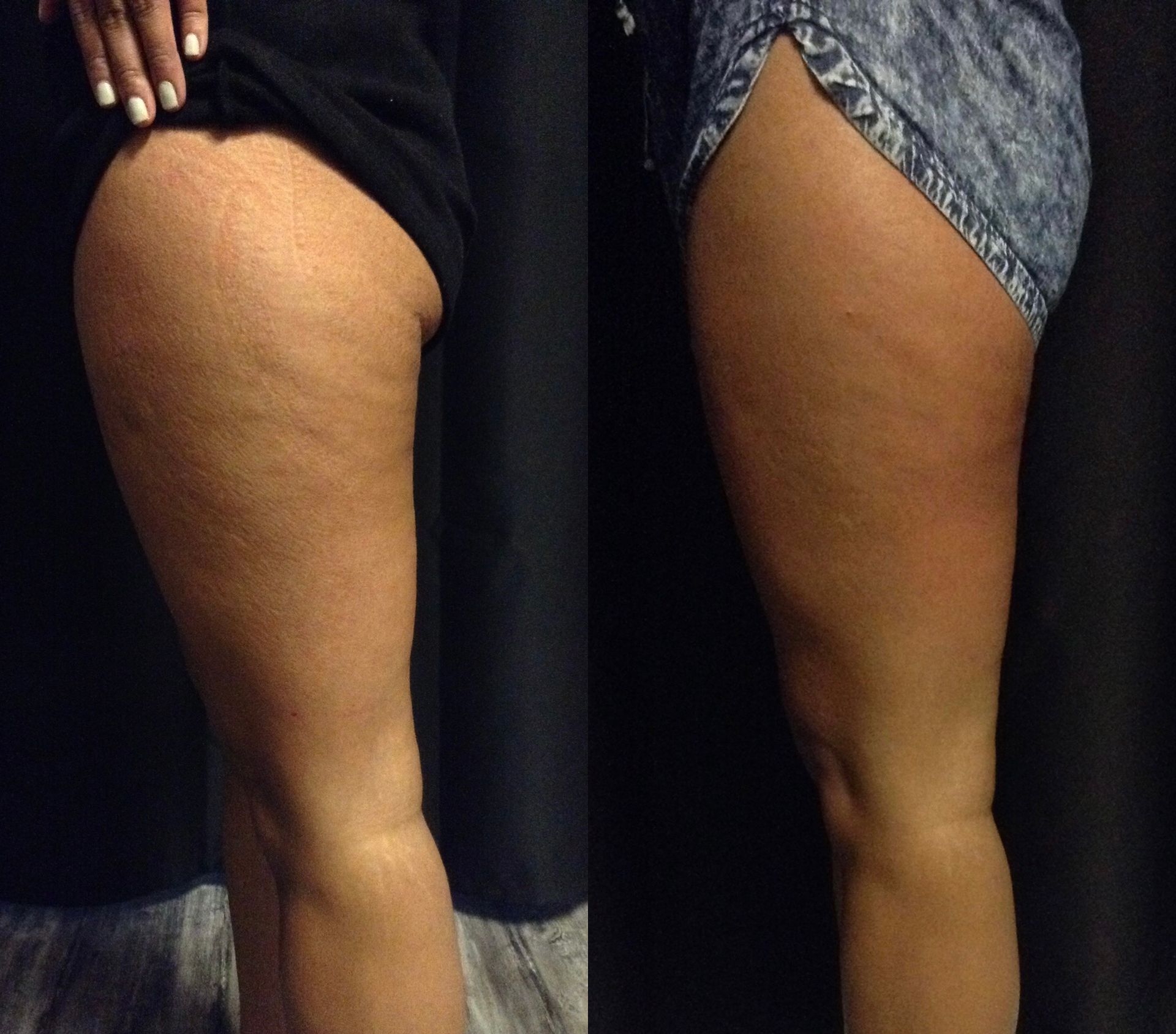 Side-by-side close-up of two people’s bare legs and thighs in different shorts against a dark background