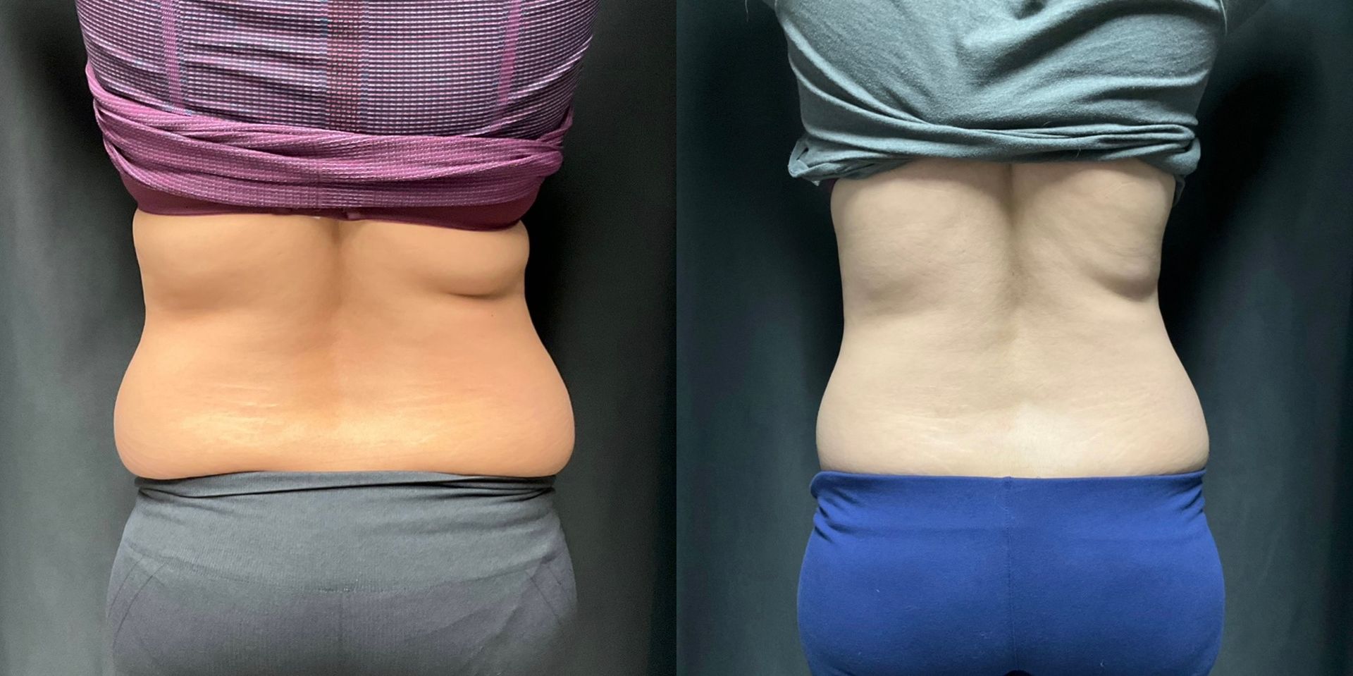 Side-by-side back views of two torsos with exposed waistlines showing skin folds, in purple and teal tops and dark leggings