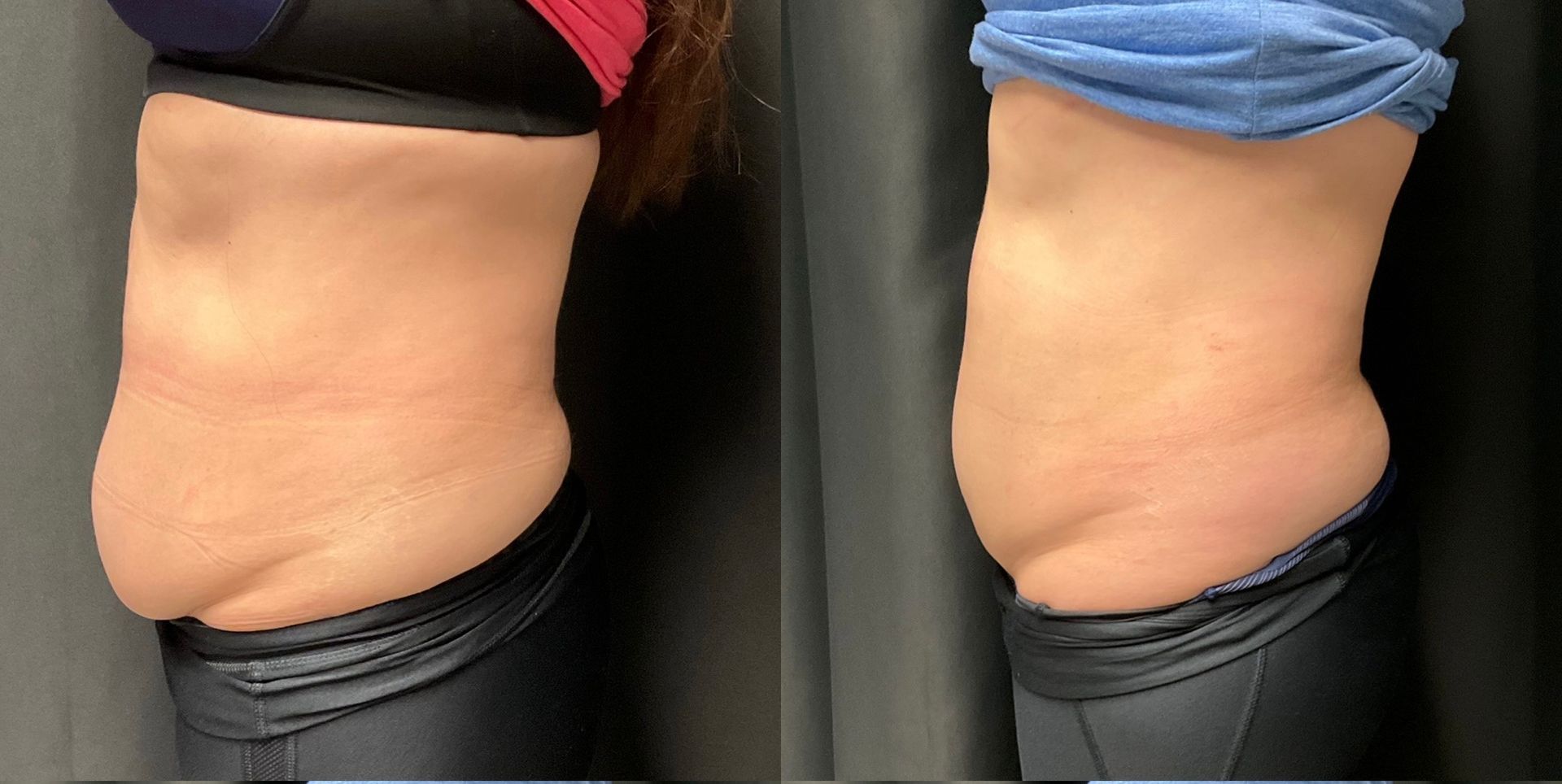 Side-by-side close-up of a torso showing belly profile in black and blue clothing.