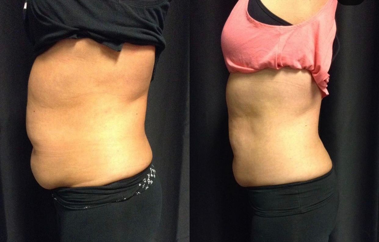 Side-by-side torso comparison showing a slimmer waist on the right and fuller midsection on the left.