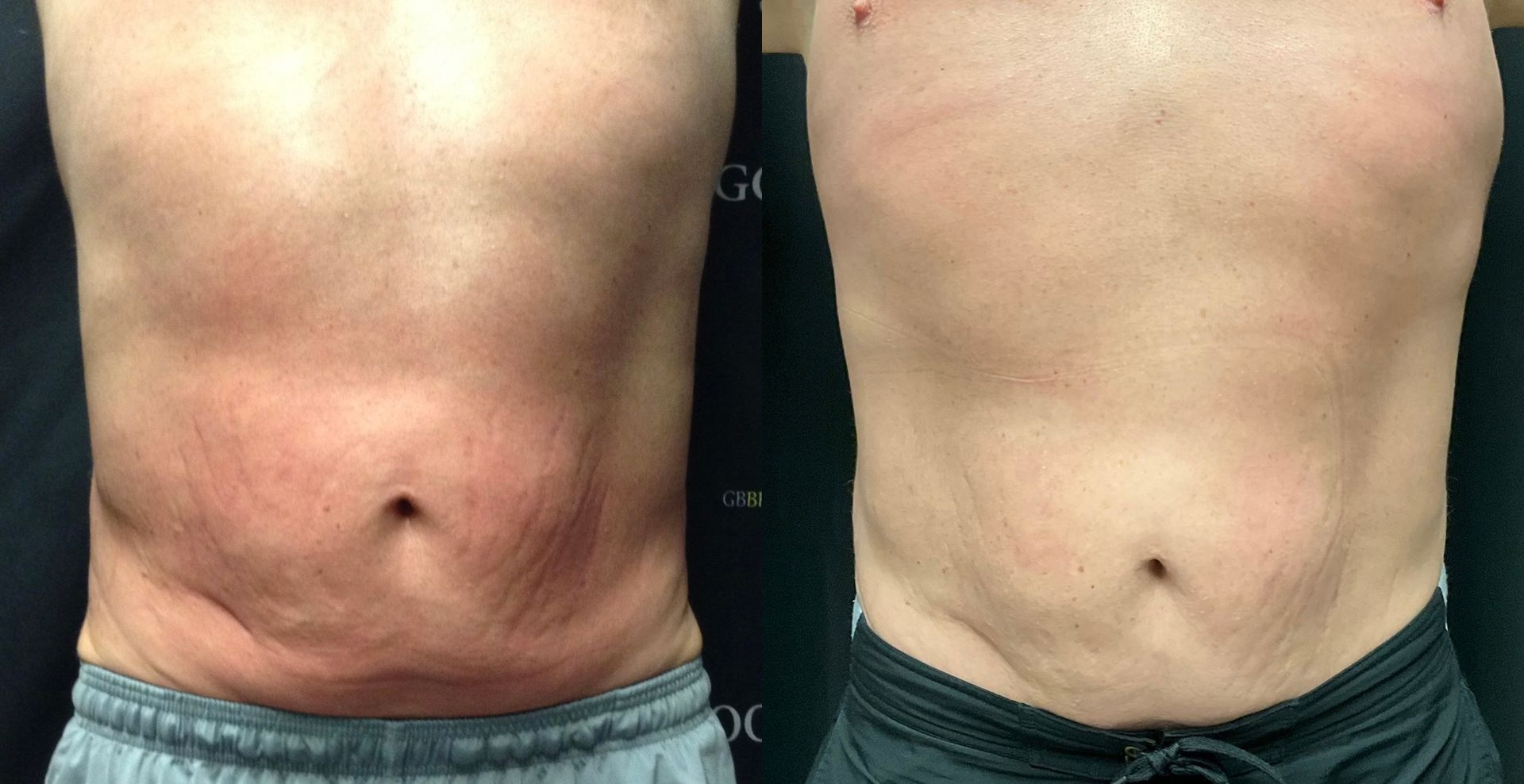 Side-by-side torso photos showing a before-and-after weight loss comparison.