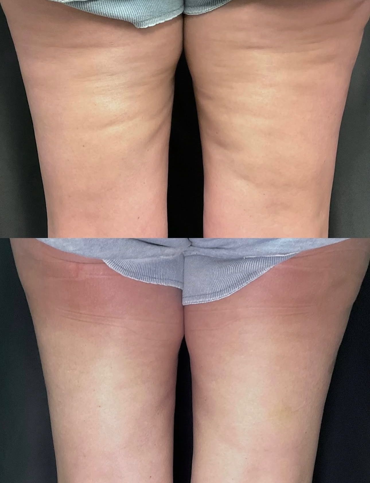 Two side-by-side photos of thighs showing skin tone changes and mild redness near the inner thighs