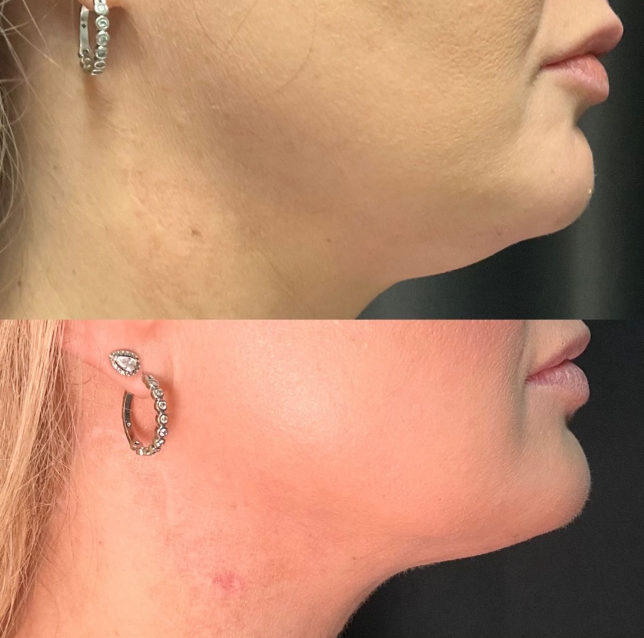 Side-by-side profile of a chin and neck before-and-after skin treatment, showing redness in the lower image.