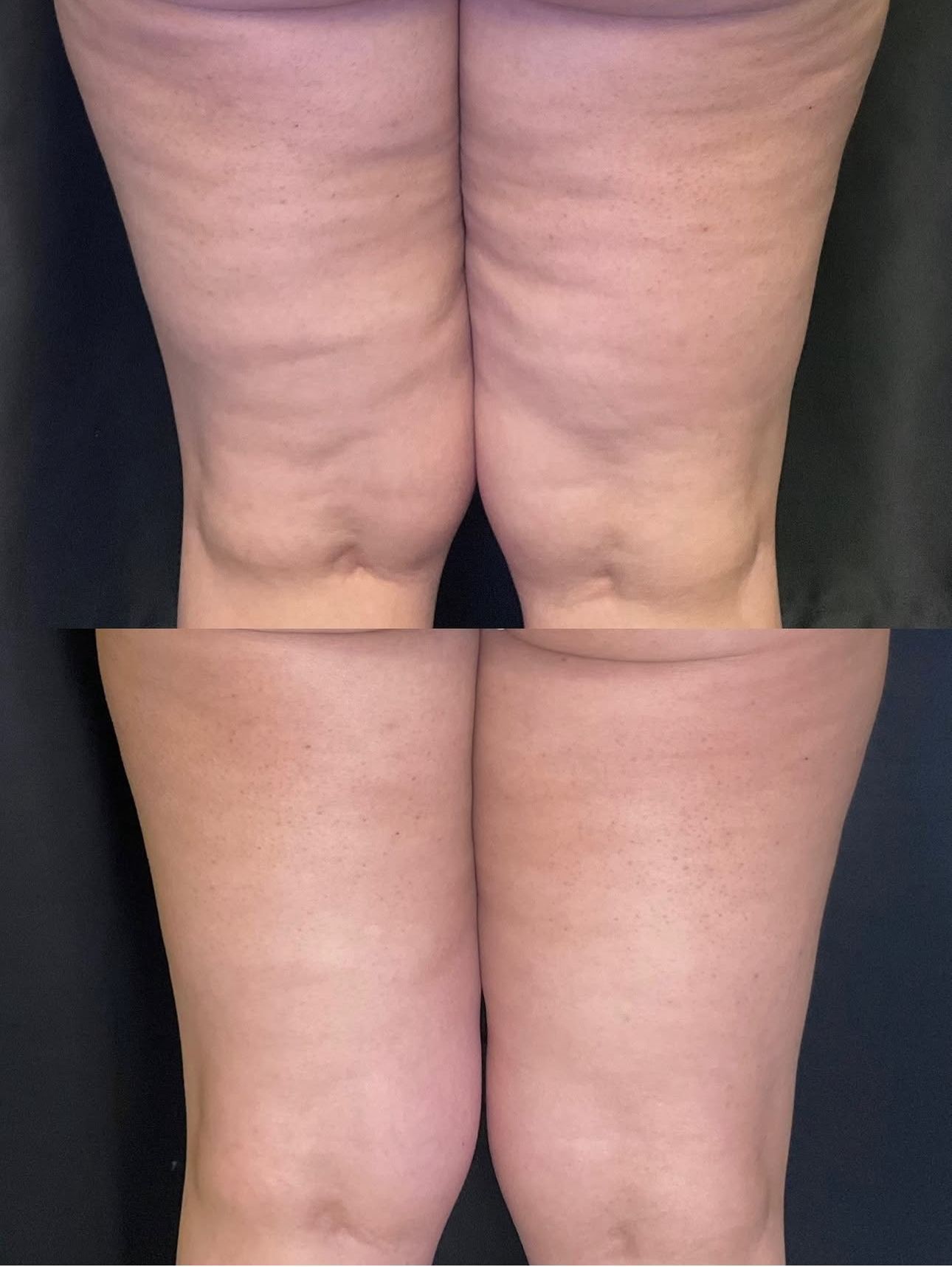 Back view of a person’s thighs, showing skin folds and dimpling before and after treatment
