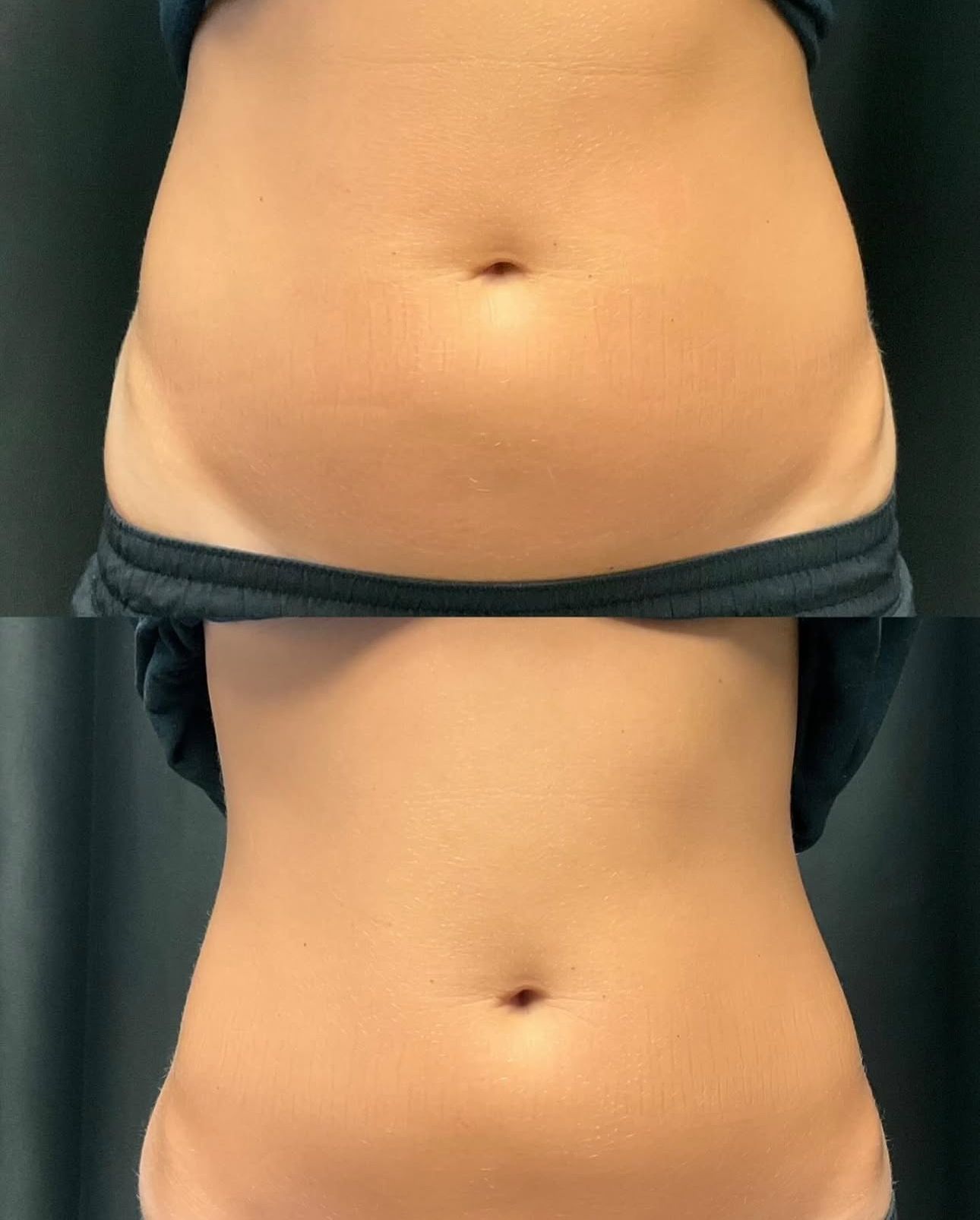 Torso with shirt lifted, showing a before-and-after abdomen comparison.