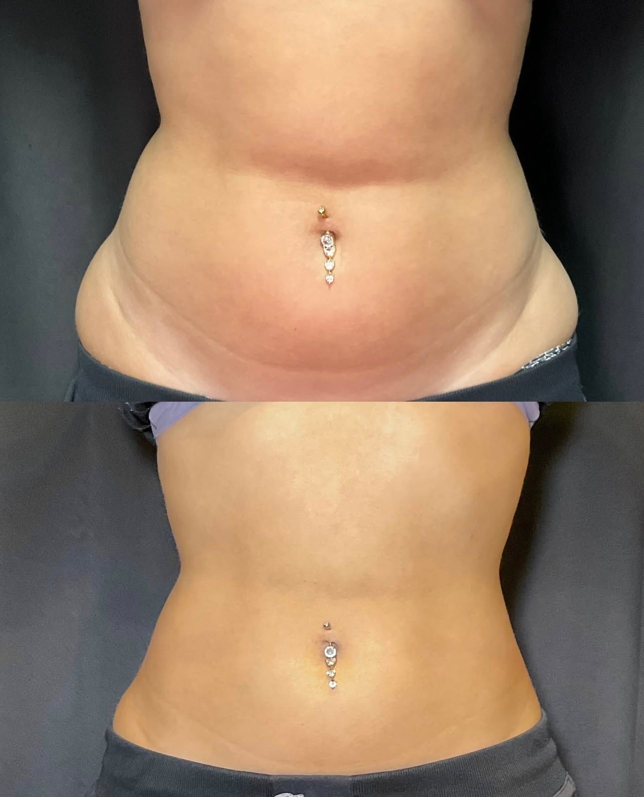 Two torso photos stacked vertically, showing a abdomen with belly button piercing, before and after