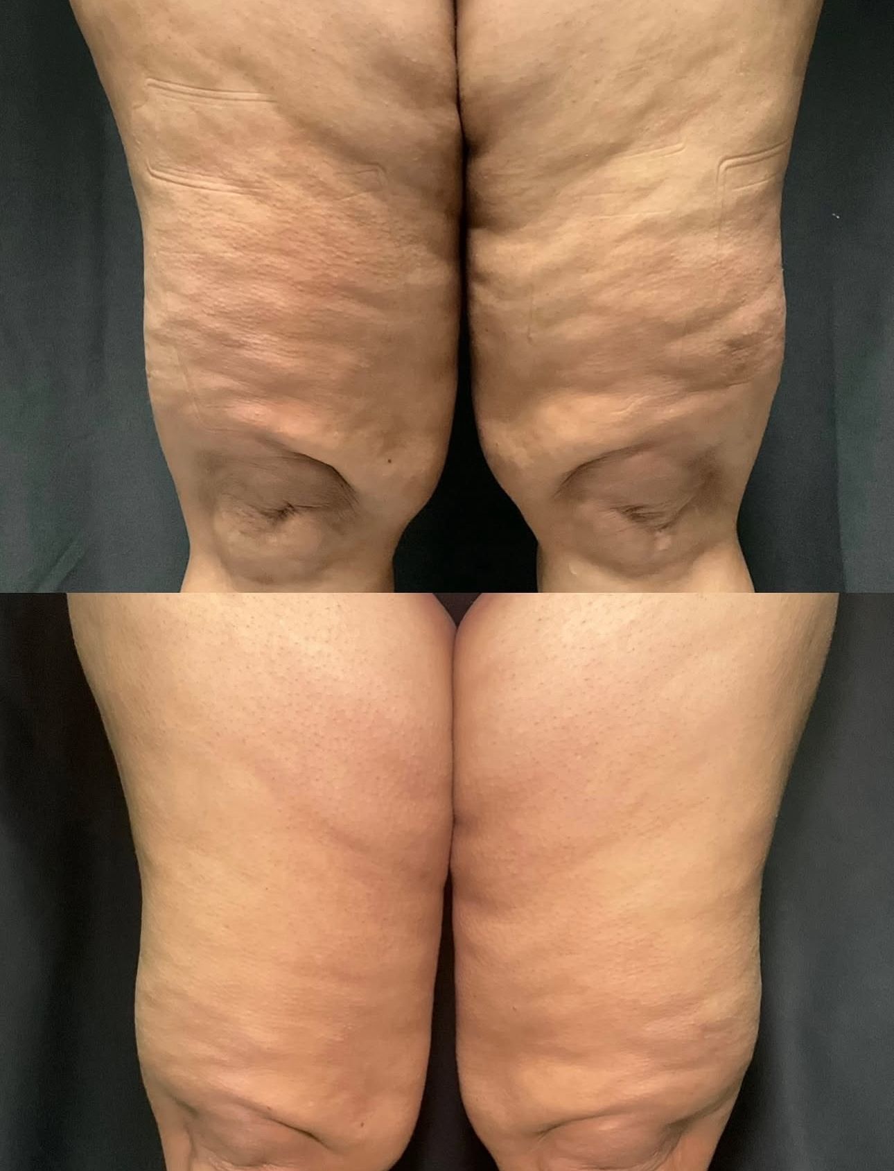 Before-and-after rear view of thighs showing reduced swelling and dimpling in the lower legs