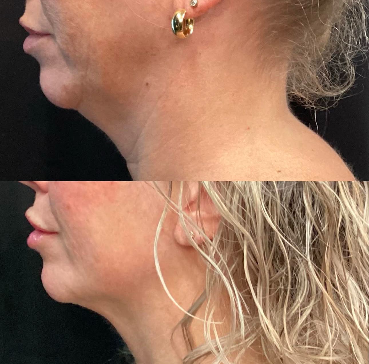 Side-by-side profile photos of a neck and jawline before and after treatment.
