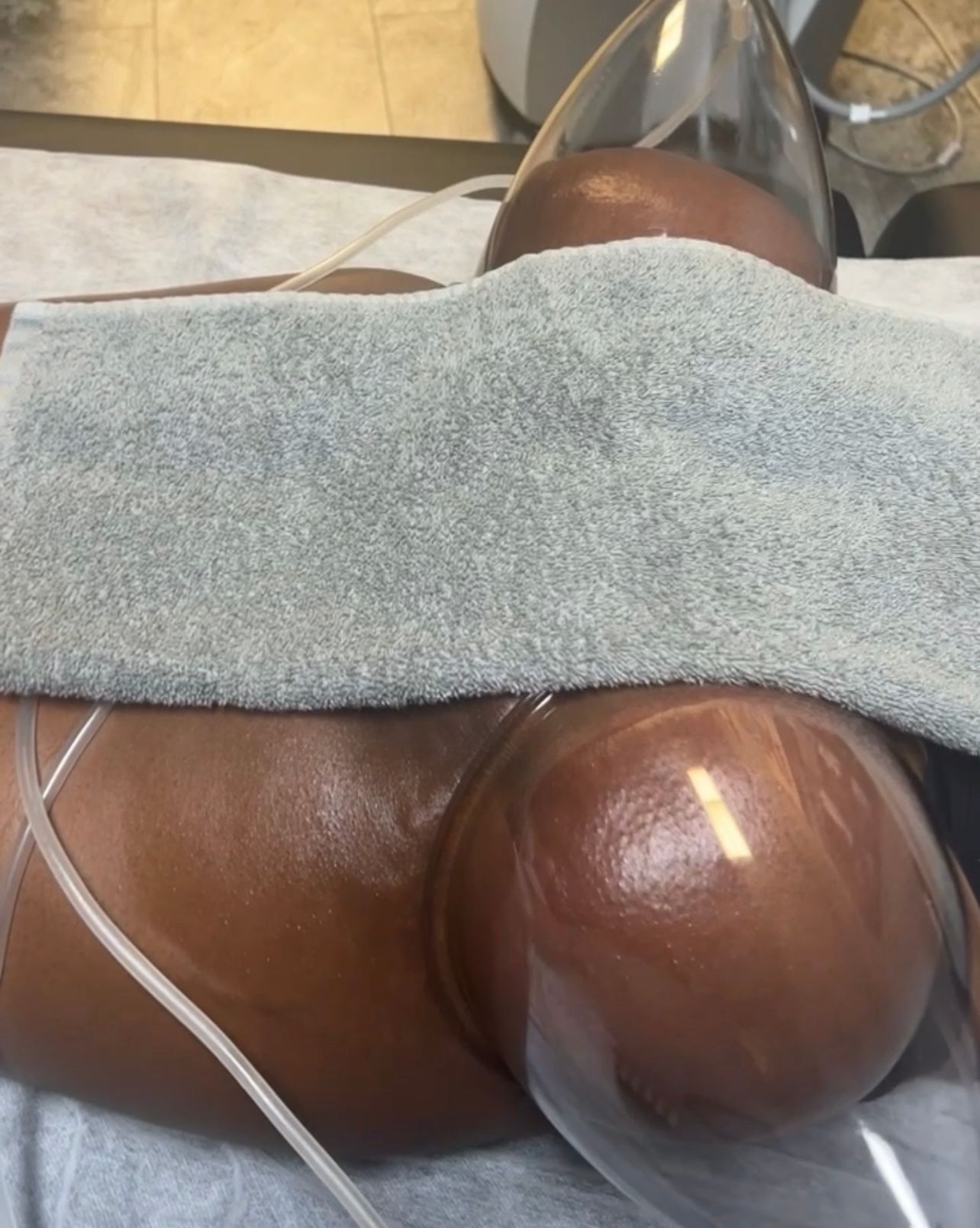 cupping therapy leftover marks