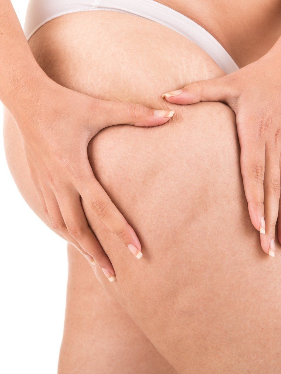 woman showing her cellulite