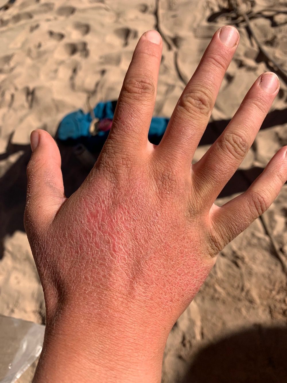 A Person 's Hand with Skin Damage