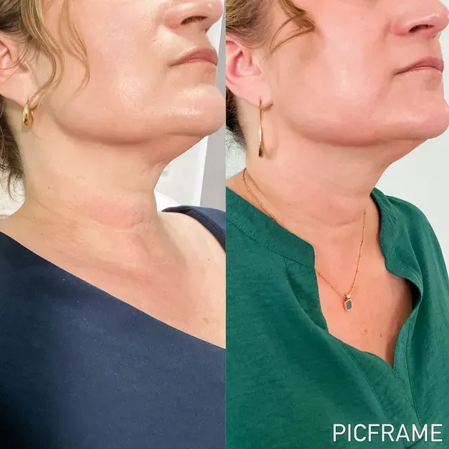 Side-by-side profile photos of a woman’s neck and jawline, before and after, wearing blue and green tops