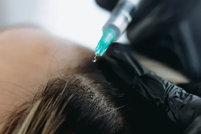 A gloved hand injects a scalp with a syringe during a hair treatment procedure.