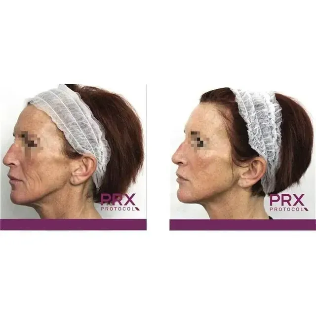 Two side-profile face photos with a lace hair cap, showing before-and-after cosmetic treatment results.