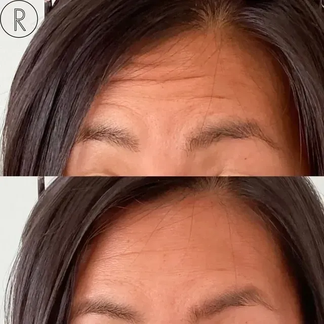 Side-by-side close-up of a forehead before and after smoothing wrinkles