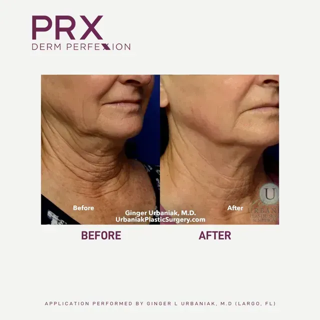Before-and-after side views of lower face skin treatment results with PRX Derm Perfexion branding.